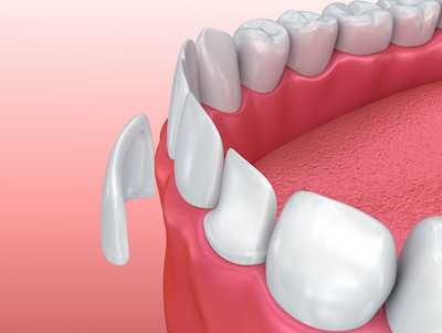 Graphic of veneer being placed on a tooth, fishers indiana