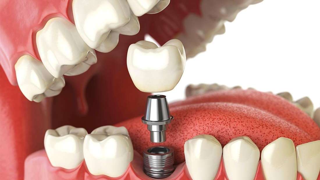 How Long Do Dental Implants Last? Dental Implants Fishers IN