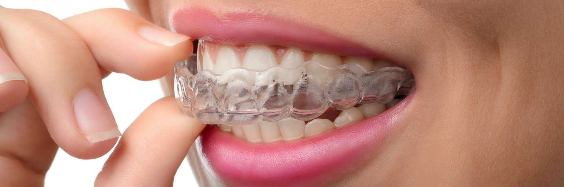 straightening teeth using Invisalign in Fisheries IN
