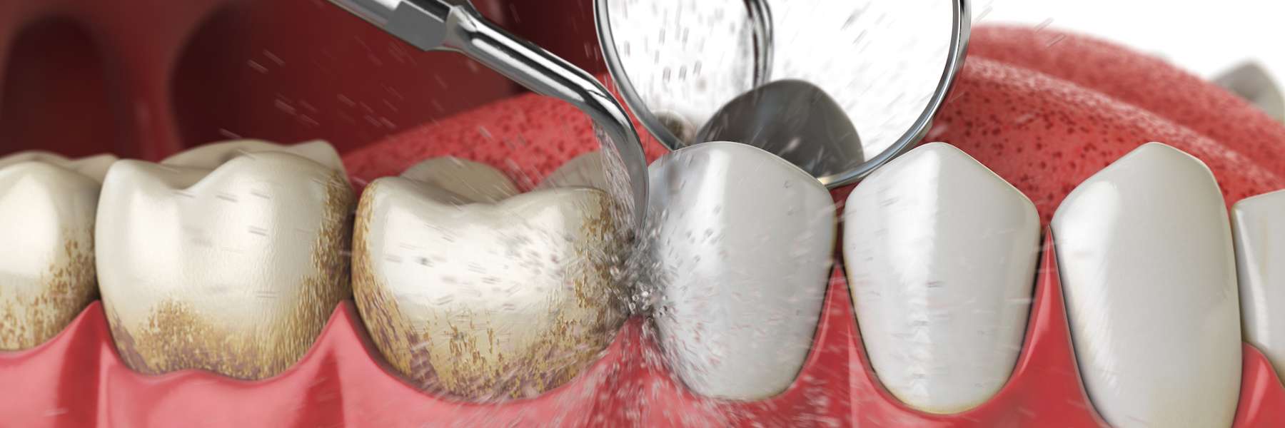 Teeth being cleaned, fishers in